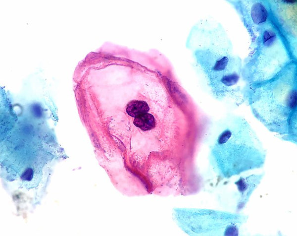 Infekcija humanim papiloma virusom